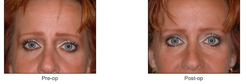 Browlift