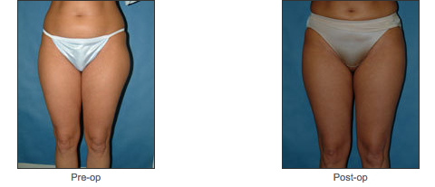 Liposuction