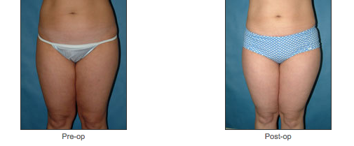Liposuction