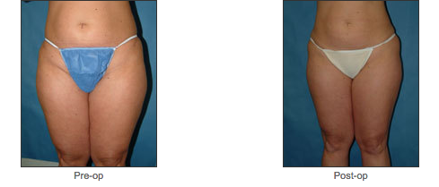 Liposuction