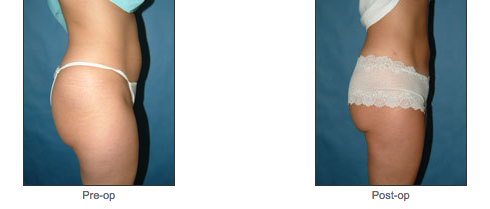 Liposuction
