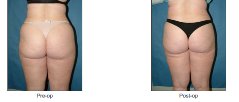Liposuction
