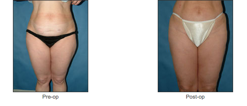 Liposuction
