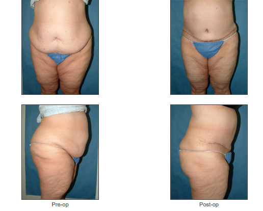 Abdominoplasty