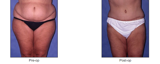 Abdominoplasty