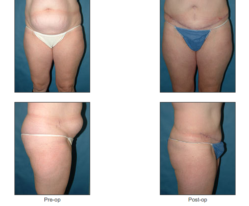 Abdominoplasty