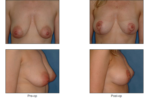 Mastopexy