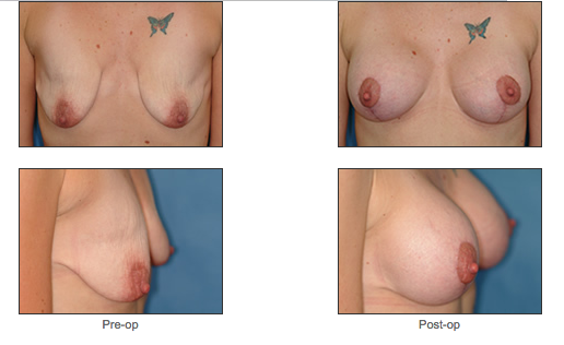 Mastopexy