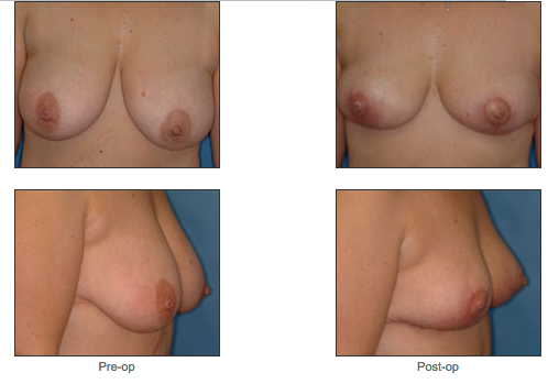Breast Reduction