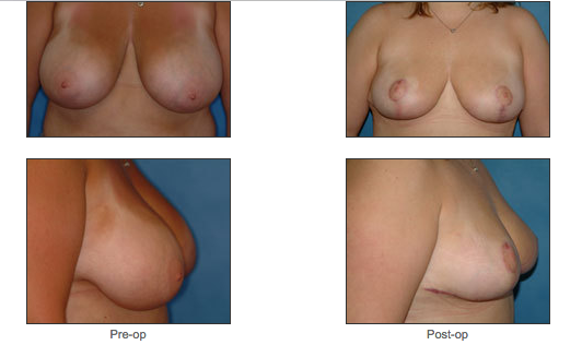 Breast Reduction