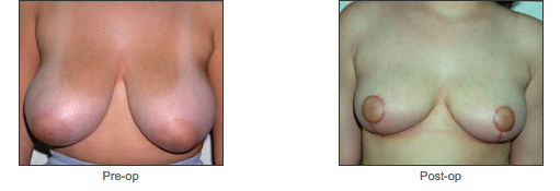 Breast Reduction