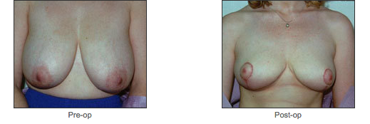 Breast Reduction