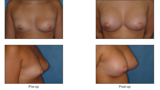 Breast Asymmetry