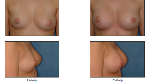 Breast Asymmetry