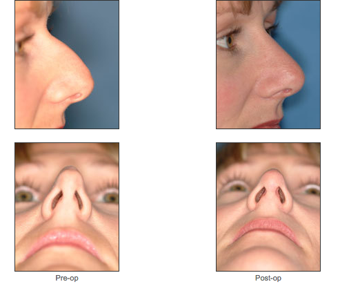 Rhinoplasty