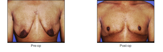 Transgender Surgery