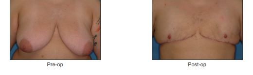 Transgender Surgery