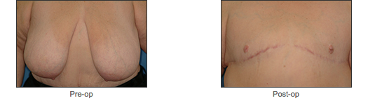 Transgender Surgery