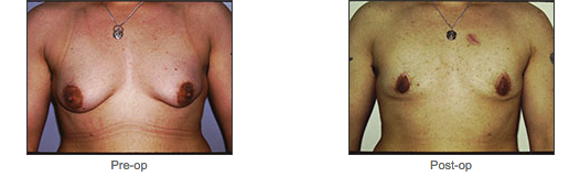 Transgender Surgery