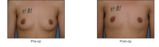 Transgender Surgery
