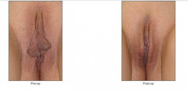 Labiaplasty