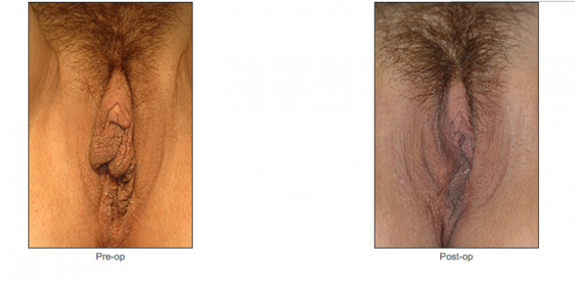 Labiaplasty