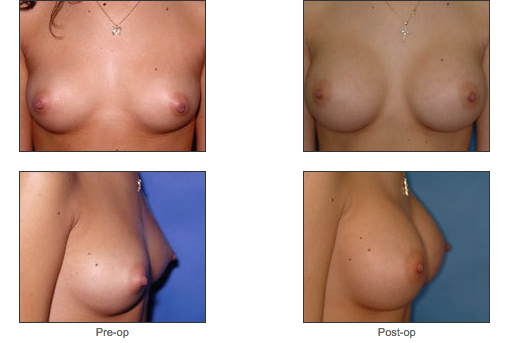 Breast Augmentation