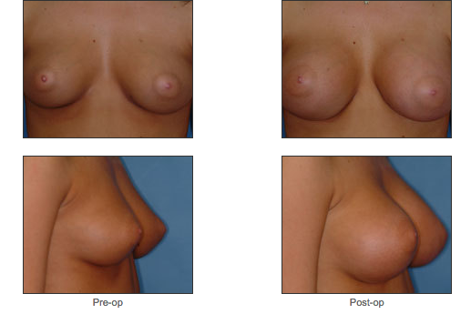Breast Augmentation