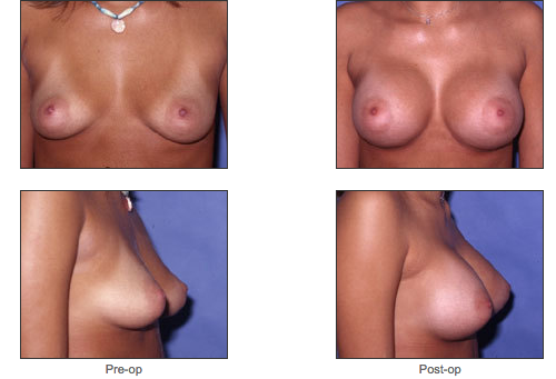 Breast Augmentation