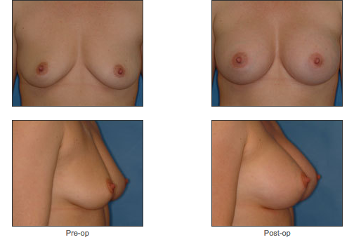 Breast Augmentation